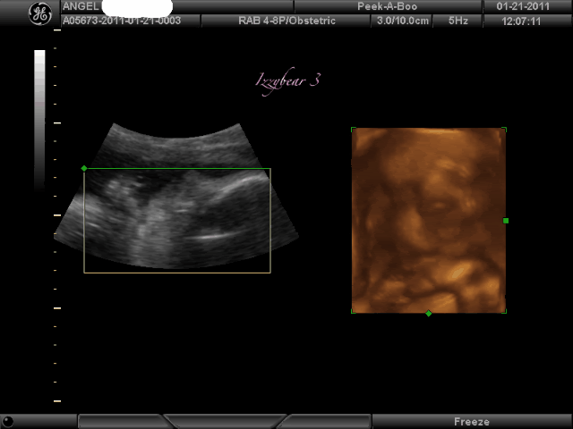 3d ultrasound scan. do 3d ultrasound pictures look